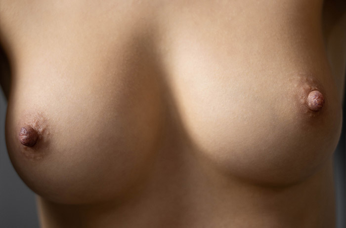 Augmentation mammaire par prothèse - Lyon - Docteur Lalloué