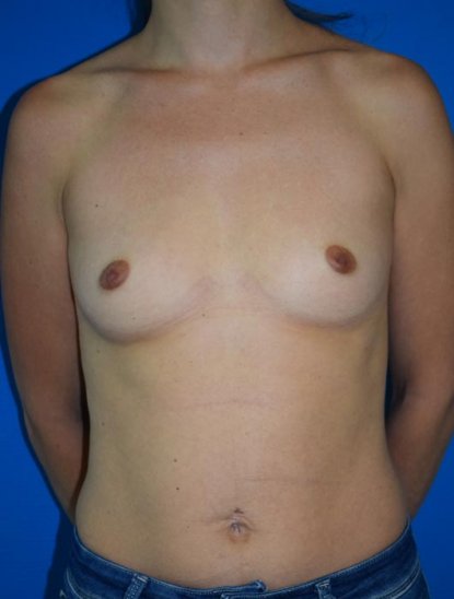 Chirurgie pour augmentation mammaire par prothèse à Lyon - Docteur Camille Lalloué