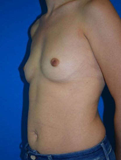 Chirurgie pour augmentation mammaire par prothèse à Lyon - Docteur Camille Lalloué