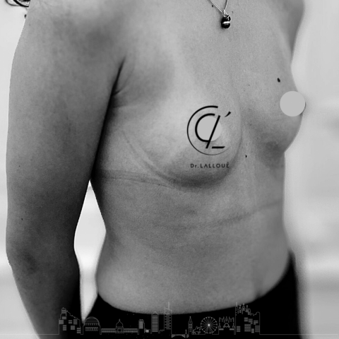 Augmentation mammaire par injection de graisse, à Lyon